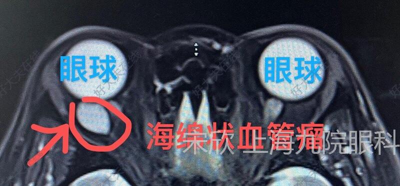 眼眶海绵状血管瘤