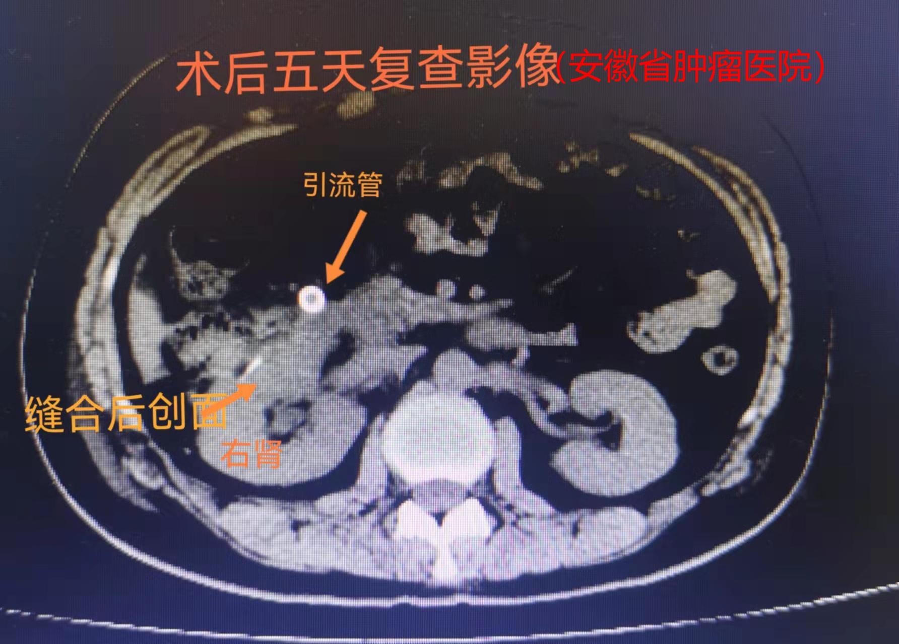 肾良性肿瘤肾脏血管平滑肌脂肪瘤肾错构瘤