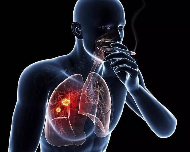 新鲜出炉中国肺癌筛查与早诊早治指南