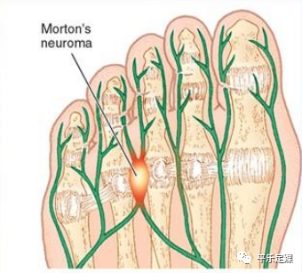 脚上有一种瘤走路会痛叫morton神经瘤