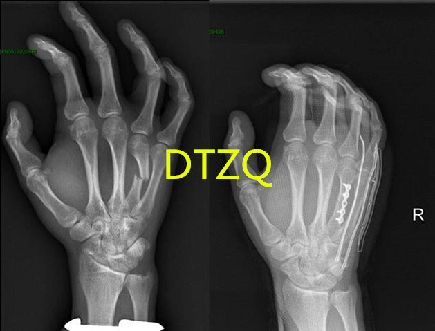 年轻人掌骨骨折手术治疗可以早期功能锻炼