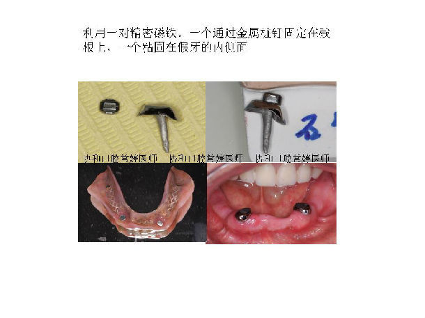 残根上面安磁铁