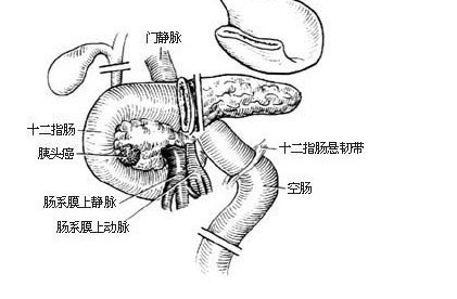 胰头或壶腹部肿瘤行胰十二指肠切除术出院后患者的注意事项
