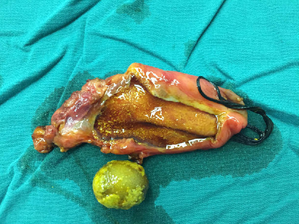 创伤最小,疤痕最小的胆囊手术——改良经脐单孔腹腔镜