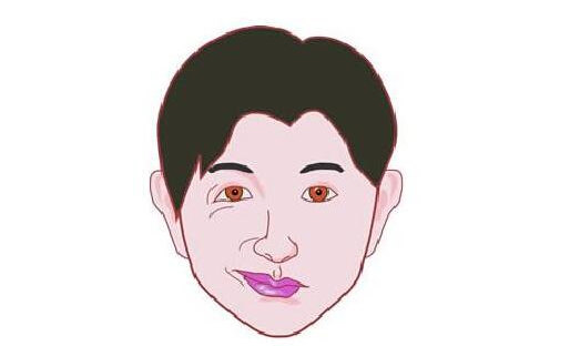 a2:面肌痉挛典型症状表现为一侧或双侧(少见)面部肌肉(眼轮匝肌,表情