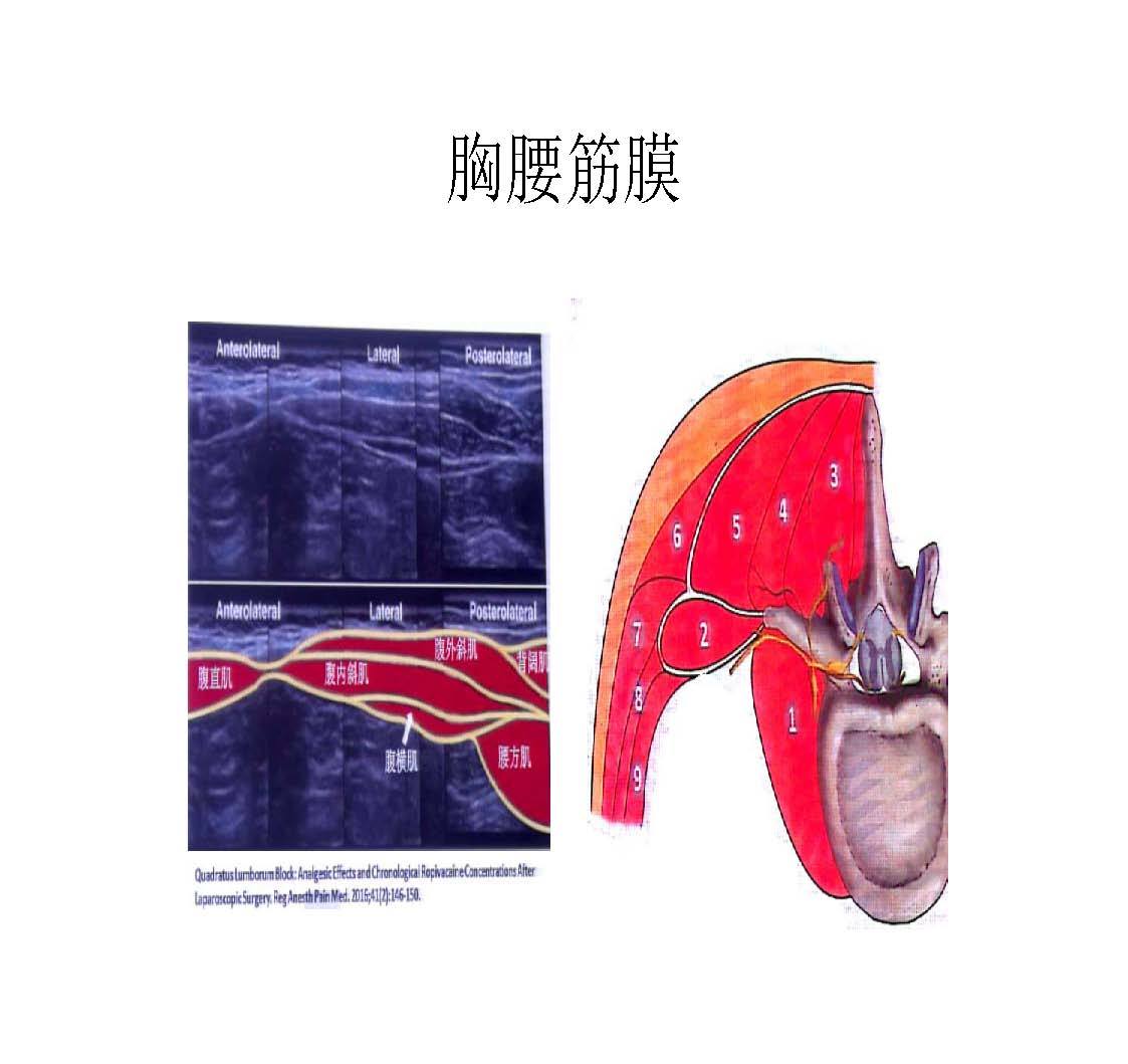 > 实用经竖脊肌平面阻滞治疗腰背部疼痛