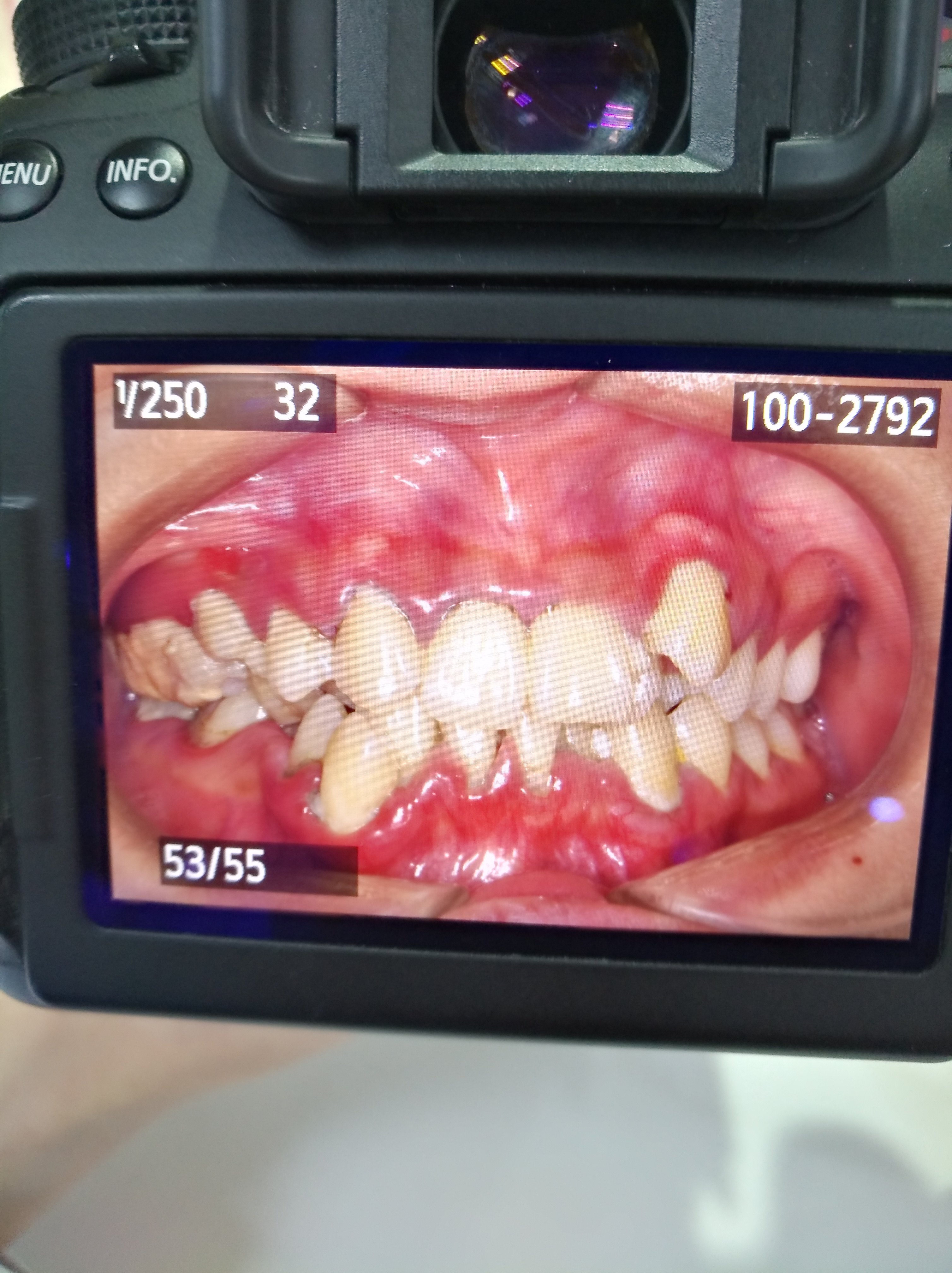 患者第一次就诊时口腔内情况:牙龈明显红肿,可见龈上牙结石,牙列拥挤