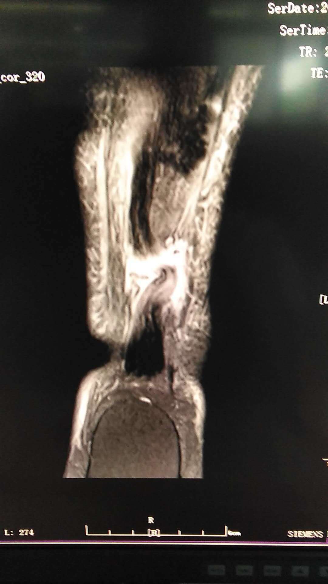 跟腱断裂诊疗经验分享