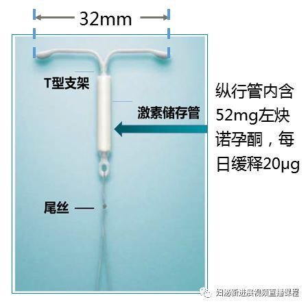 子宫内膜息肉不可怕曼月乐轻松搞定无生育要求者