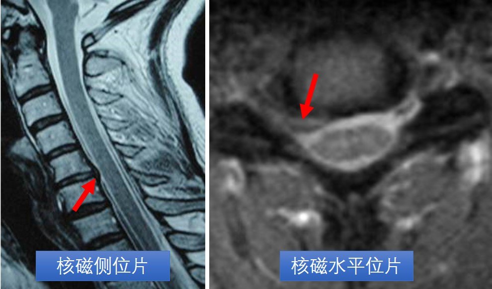 颈椎核磁:颈5-6节段椎间盘突出,偏向右侧,压迫右侧颈神经根