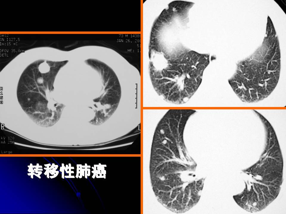 什么样子的肺部病灶是肺癌?肺癌影像学 