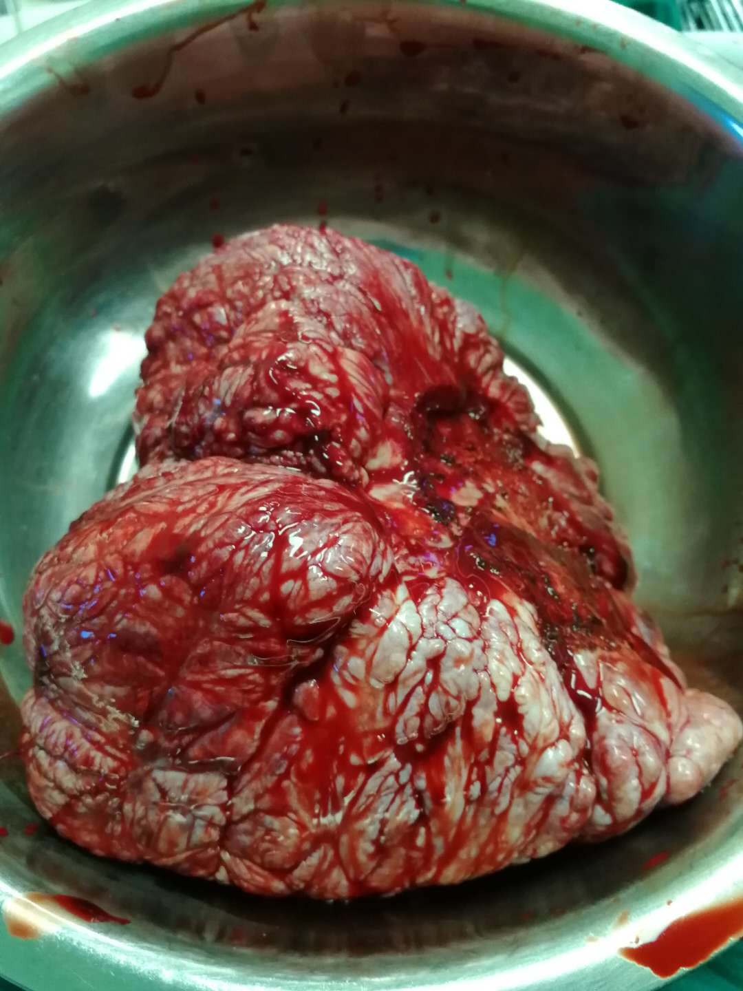 胸腔内的巨大肿瘤孤立性纤维瘤