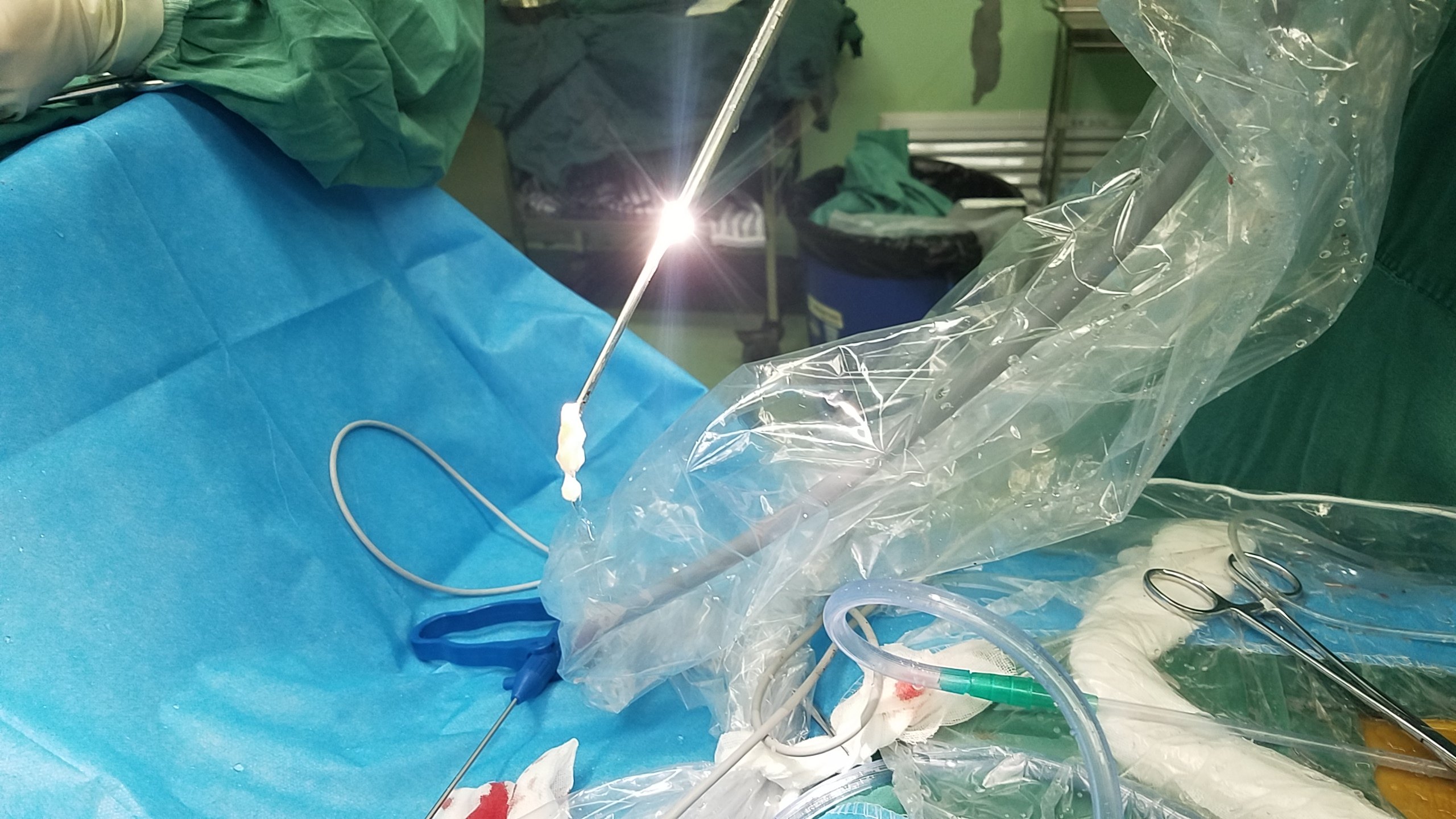 椎间孔镜-治疗腰椎间盘突出症最微创的手术技