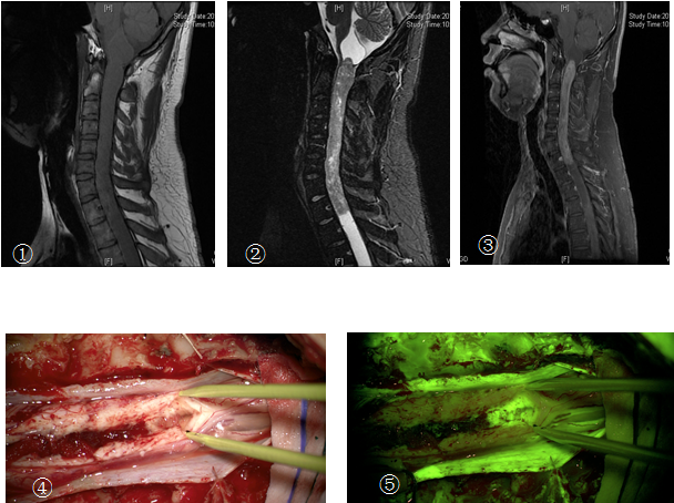 荧光下多节段高位脊髓髓内室管膜瘤手术治疗策略