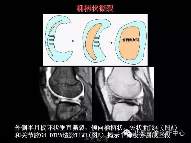 庞智晖 【医学科普】半月板和韧带核磁共振诊断 来源:华夏影像诊断