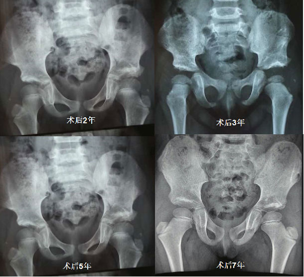 髋关节脱位系列1:一期手术治疗双侧脱位及随访效果