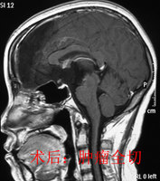 冠切右额开颅颅咽管瘤(钙化)切除术_好大夫在