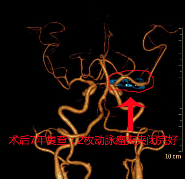 右侧翼点开颅颈内动脉床突段动脉瘤夹闭7年后复查