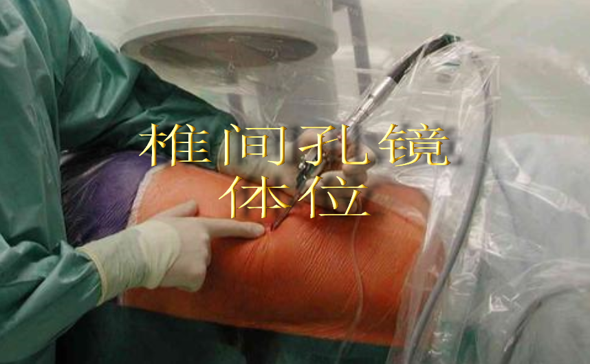 椎间孔镜治疗腰椎间盘突出