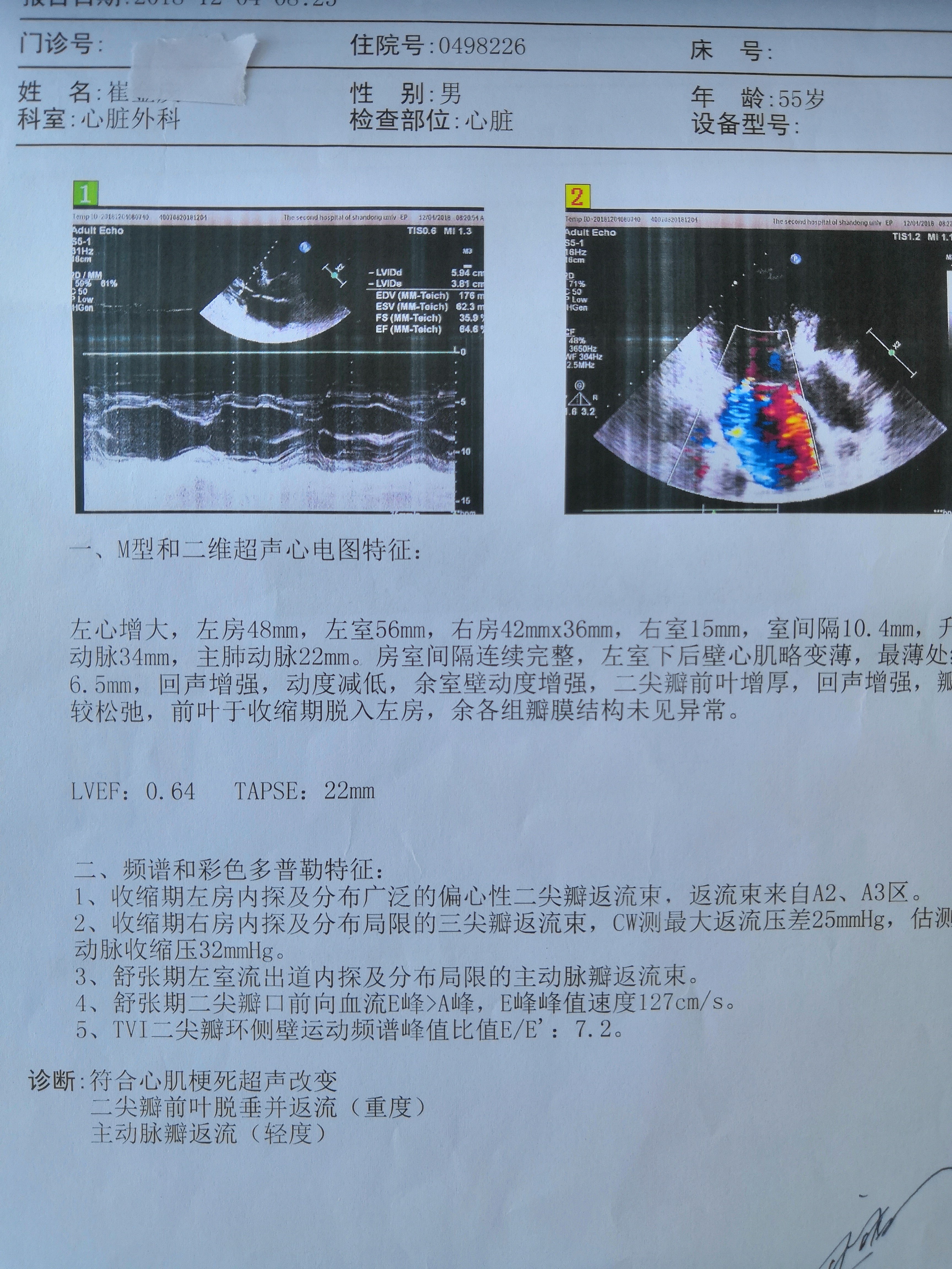 急性心肌梗塞右冠闭塞左主干二尖瓣反流