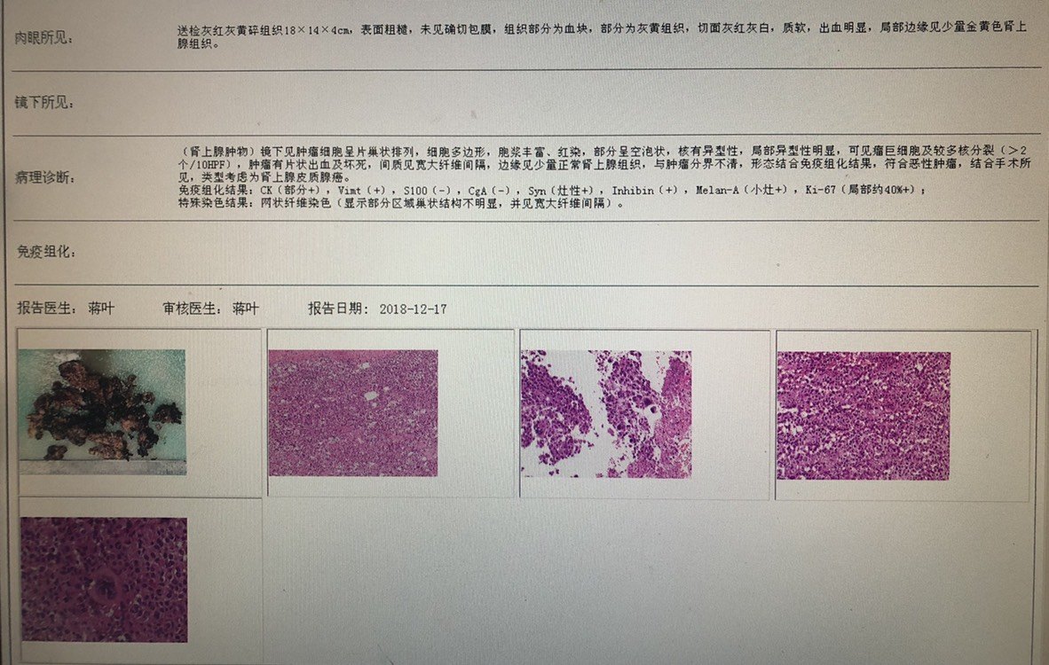 术后病理提示,肾上腺皮质腺癌