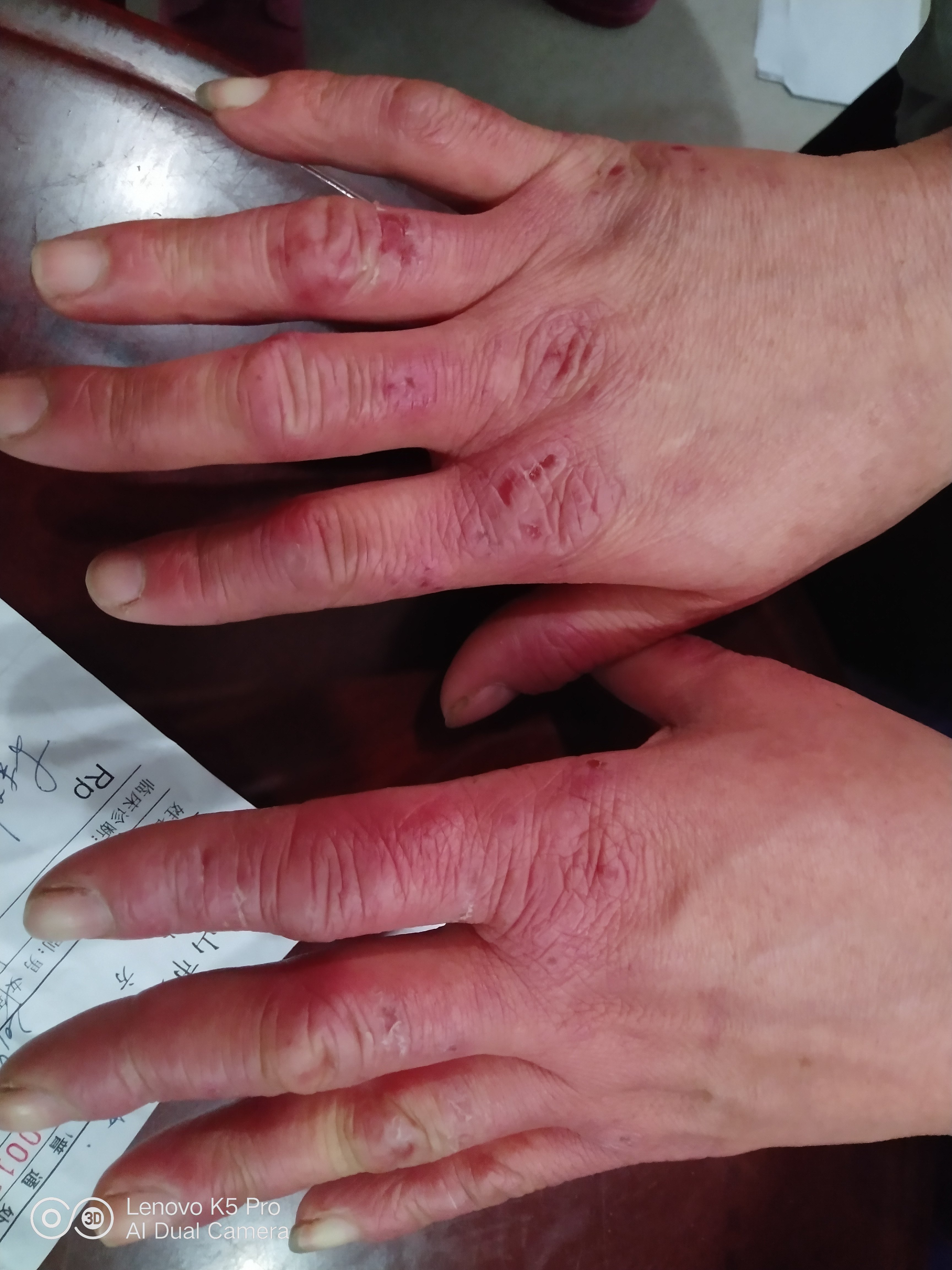 可以治冻疮_抗生素软膏治冻疮_如何治冻疮