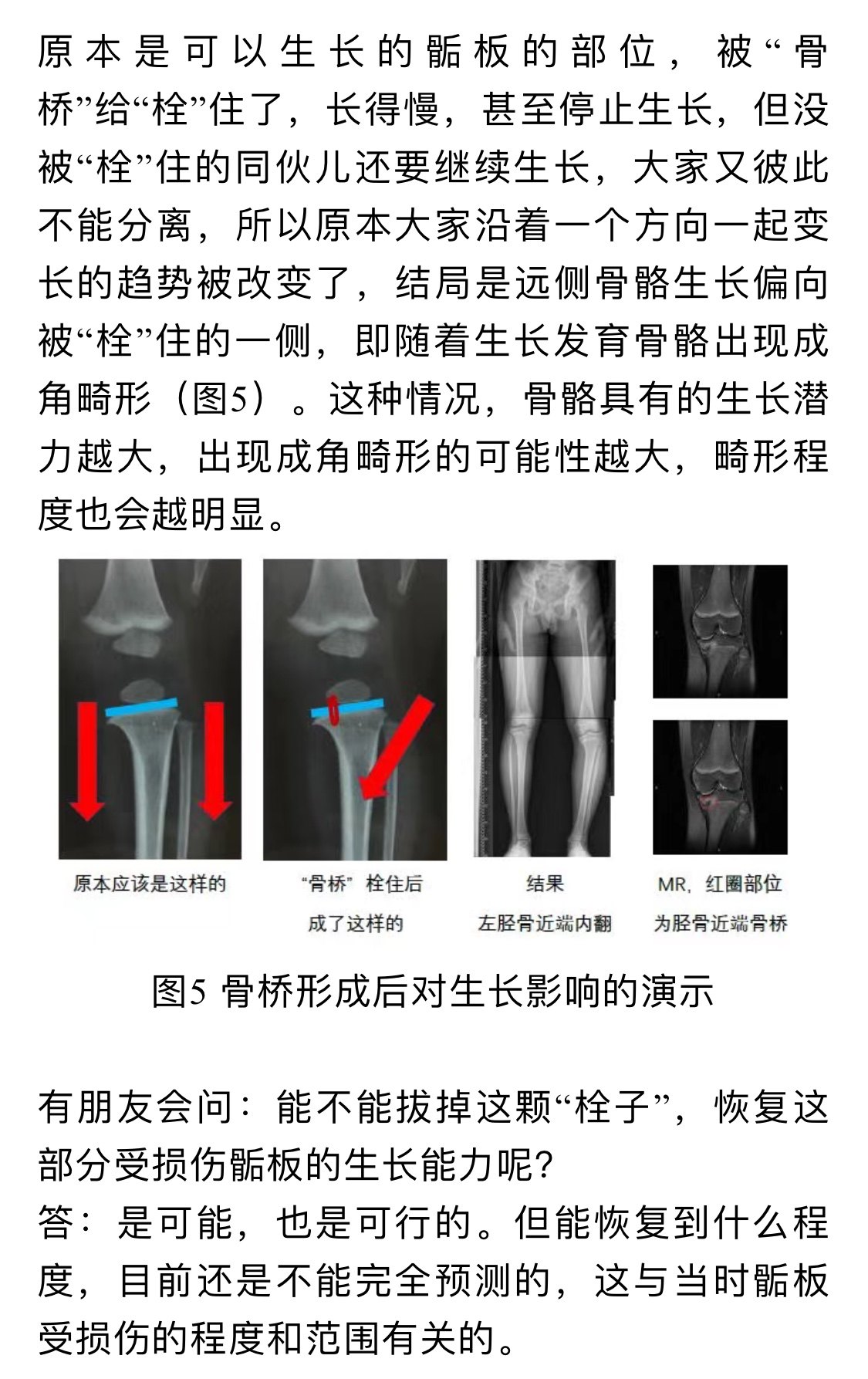 什么是"骺板骨桥"?