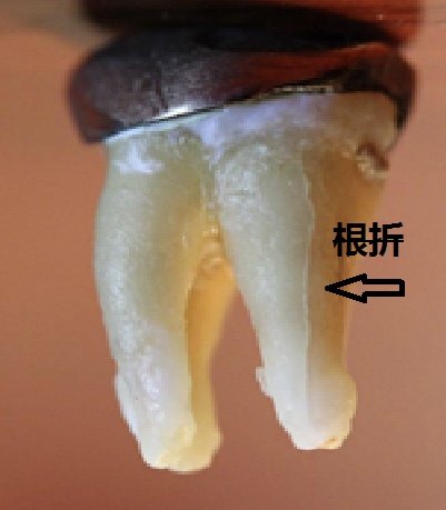 病例五,近期着5个病例给我的启示:牙套主要保护牙齿冠部不纵向折裂,并