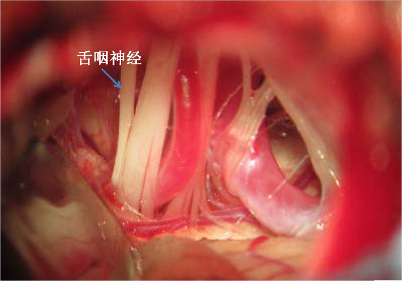 图示舌咽神经的根部被压迫的情况