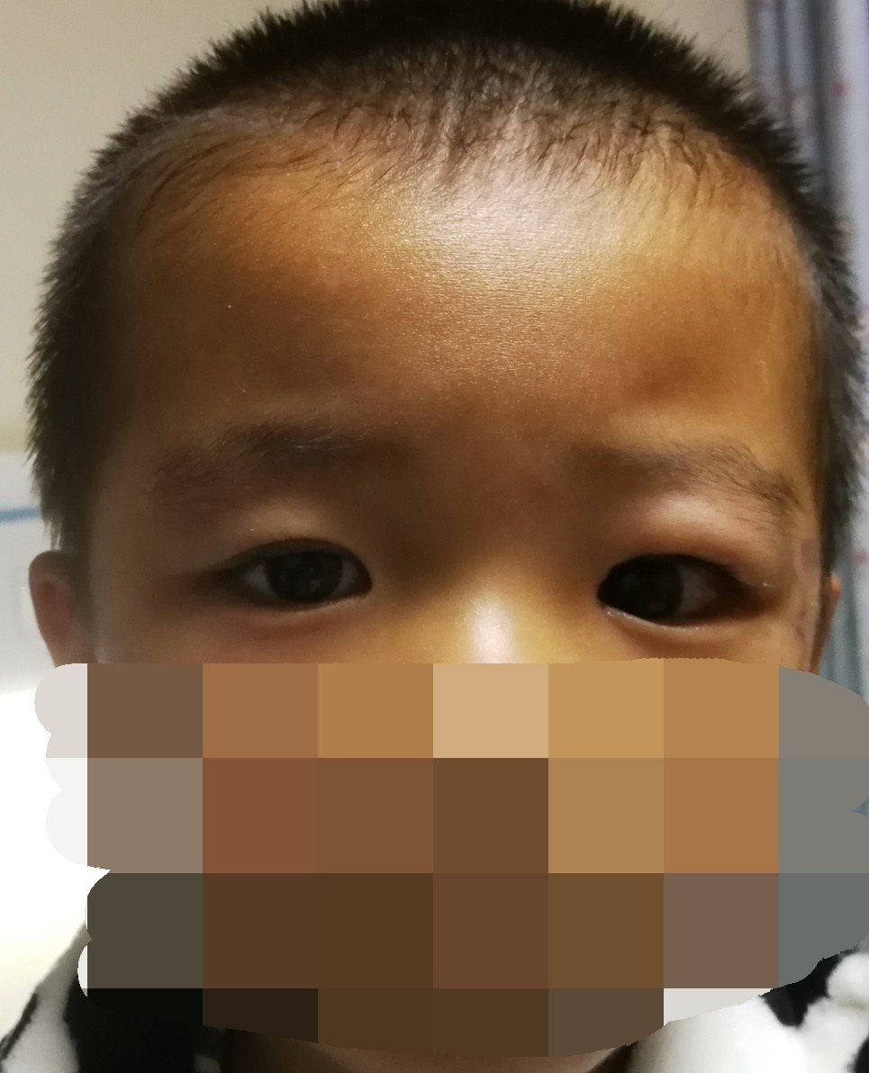 改良联合筋膜鞘悬吊cfs矫正低龄儿童上睑下垂效果对比