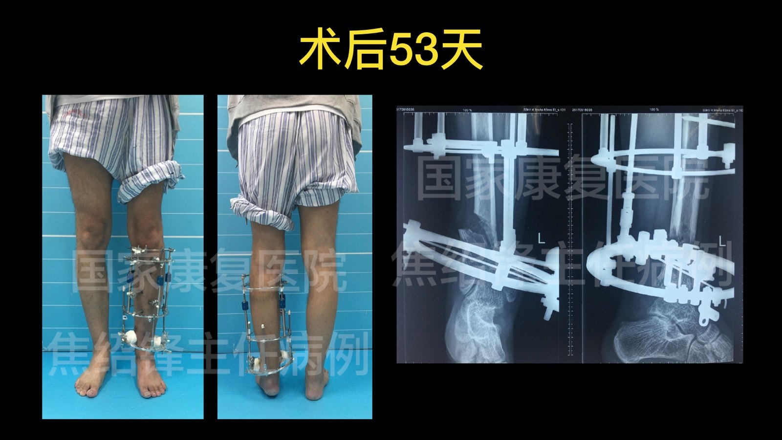踝内翻畸形的矫正主要通过踝上截骨进行矫正,即在胫骨踝关节面近端