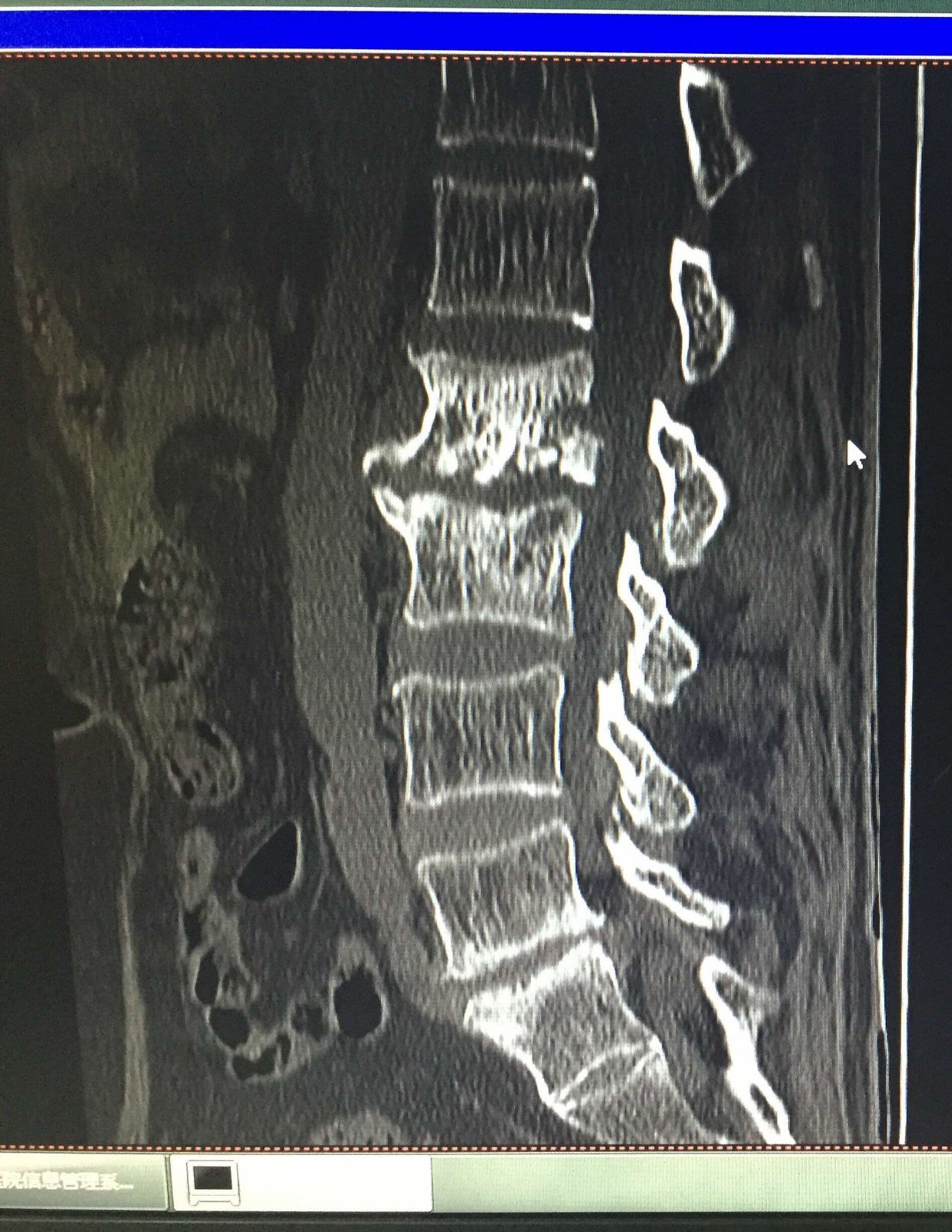 一例重度腰椎结核的治疗分享