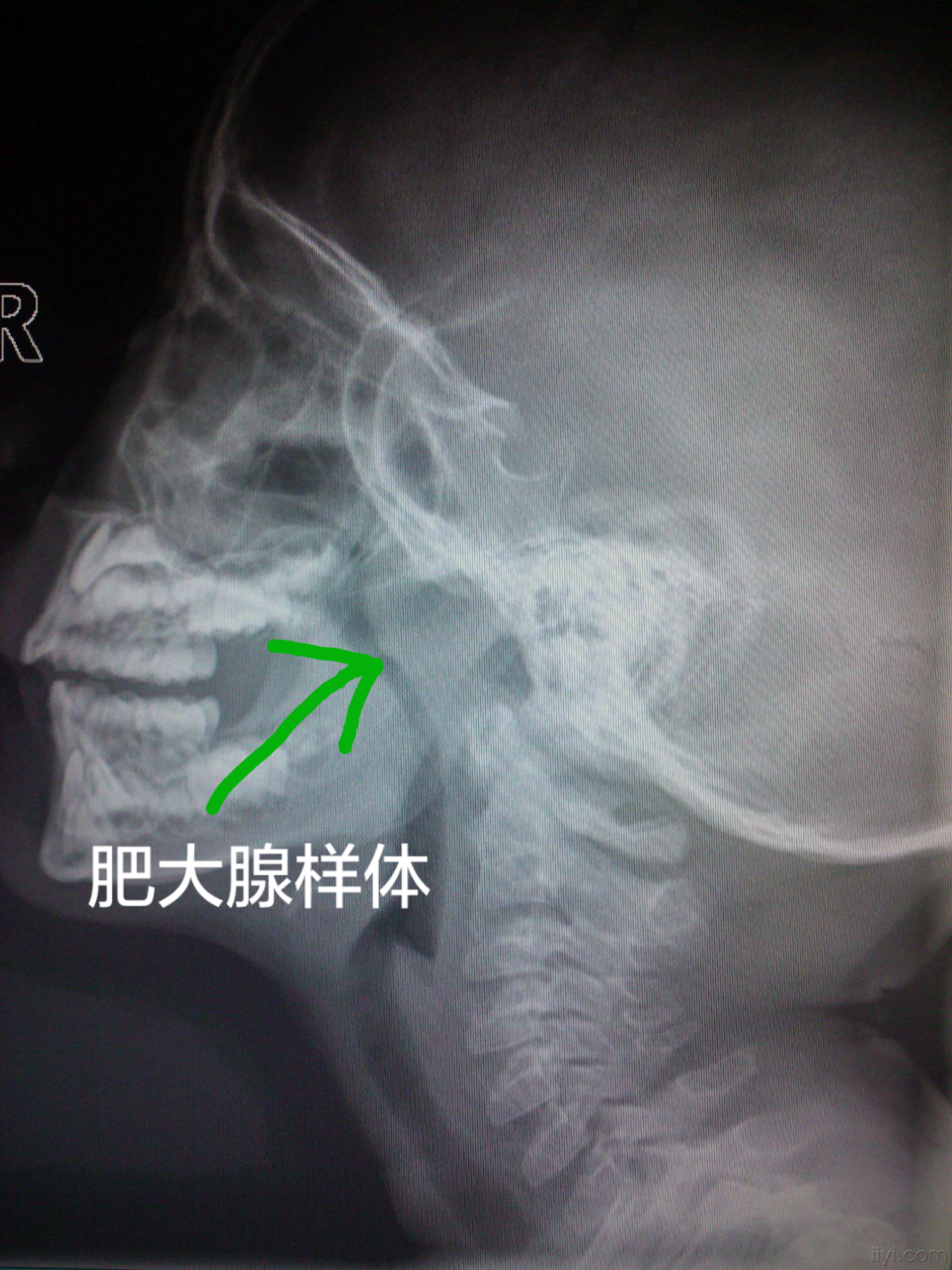 儿童反复清嗓咳嗽张口呼吸腺样体肥大惹的祸