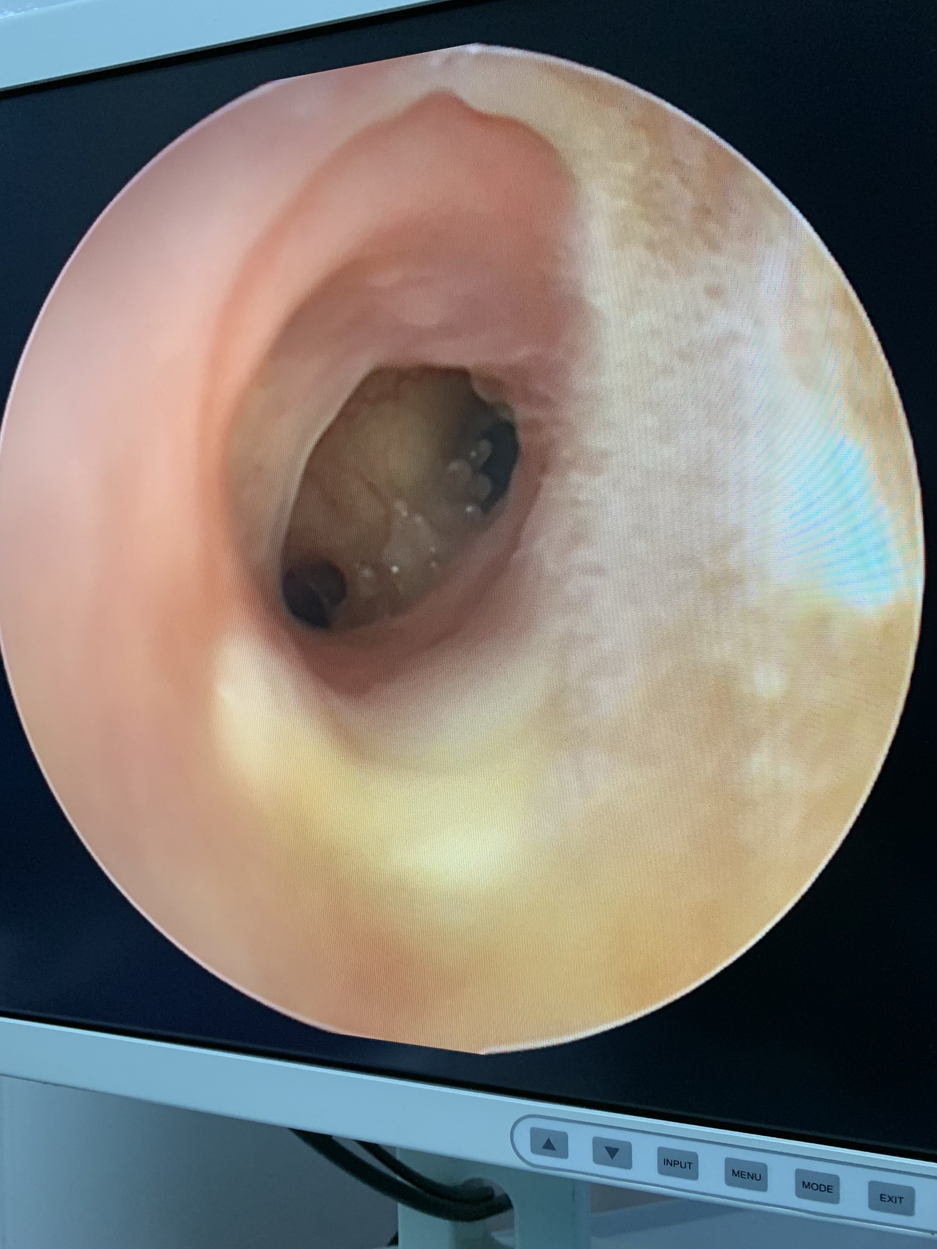 一例典型的真菌性外耳道炎并有鼓膜穿孔