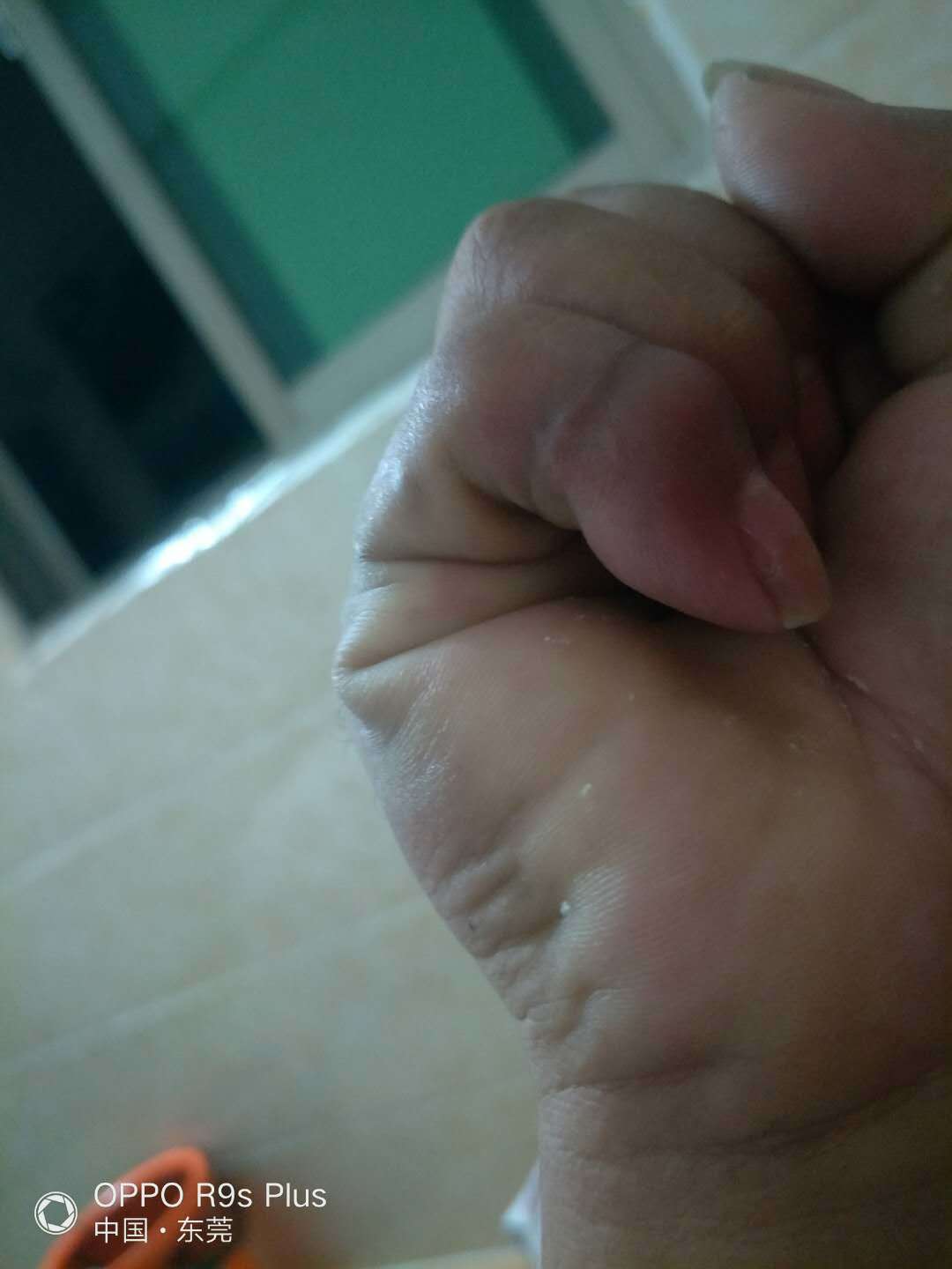 手指关节挛缩畸形的治疗