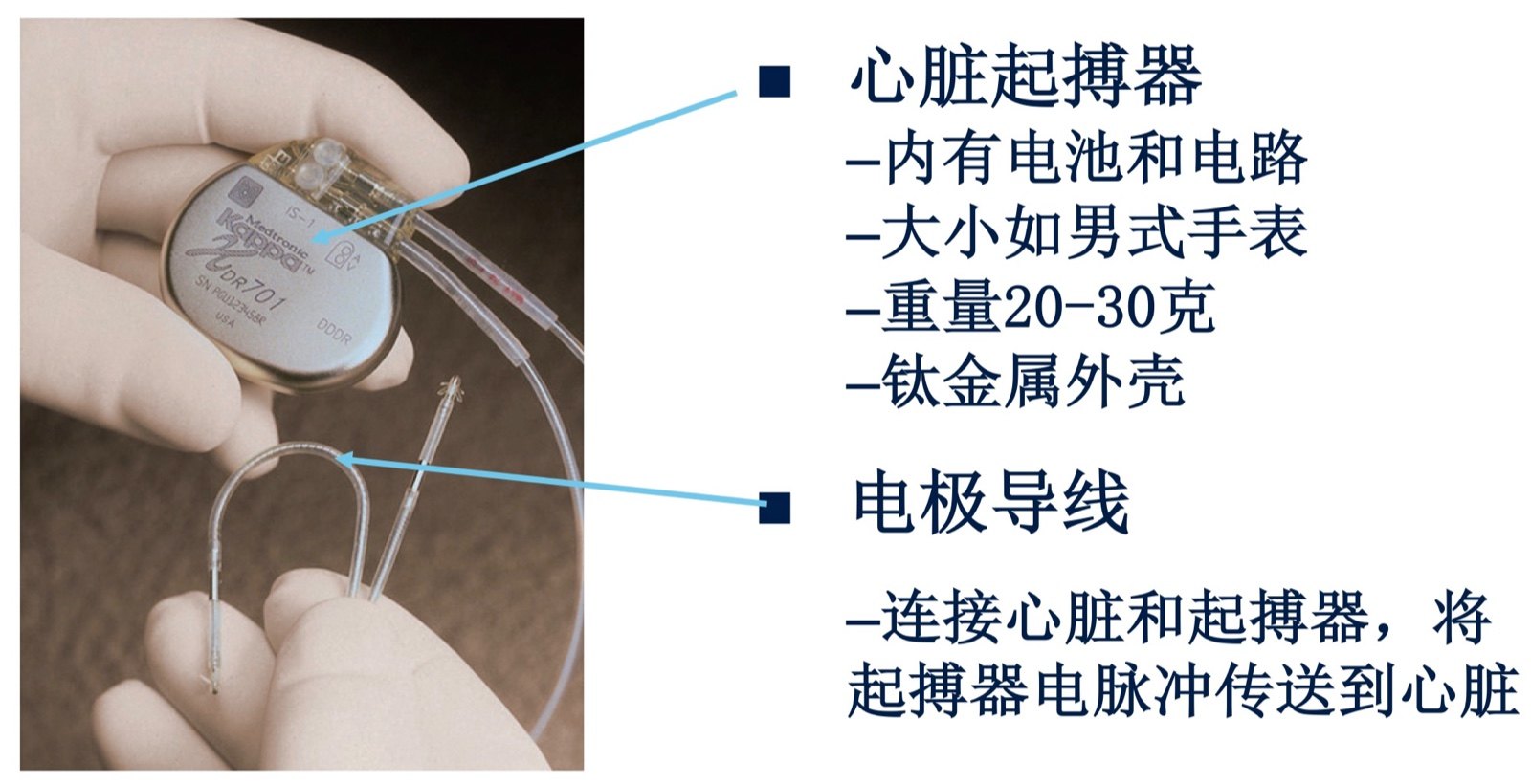 术者通过穿刺静脉将起搏导线送到心脏中合适的位置,再将脉冲发生器与