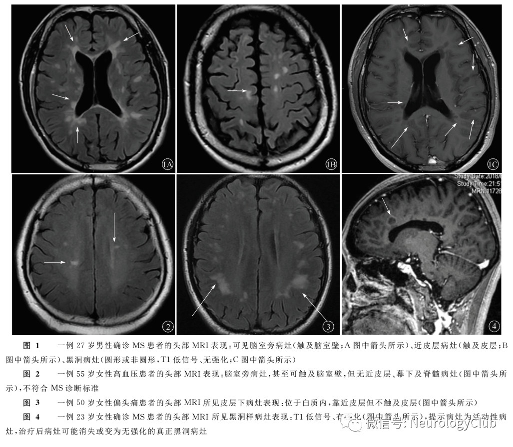 专家述评:多发性硬化:正确理解影像术语,选择合适影像