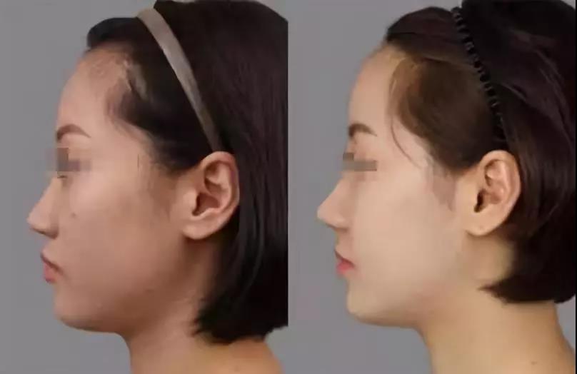 什么是艺术骨雕隆鼻
