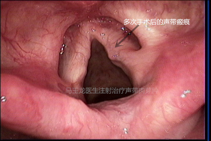 声带肉芽肿的就诊过程体验