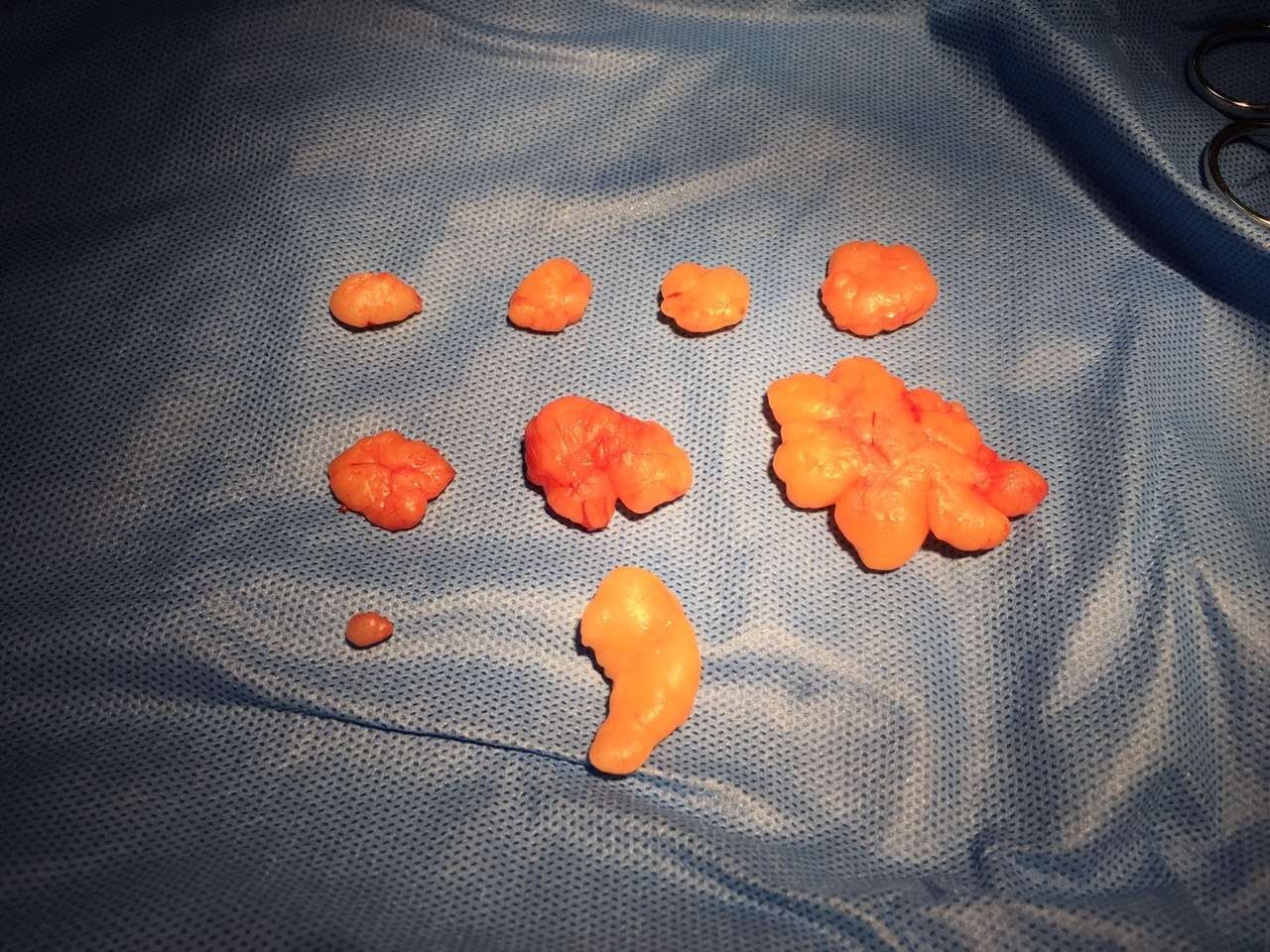 脂肪瘤怎样才能留小疤?