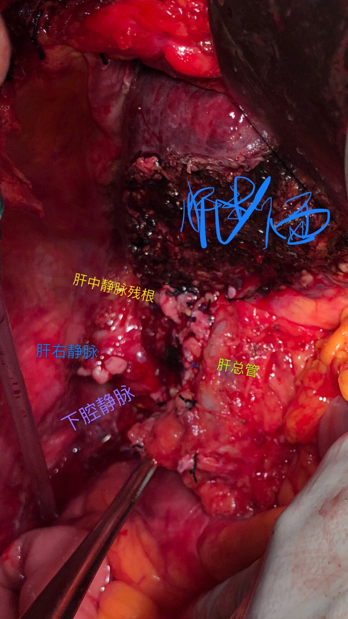晚期巨块肝癌手术:b级肝功门静脉肝中肝右静脉癌栓右半肝切除
