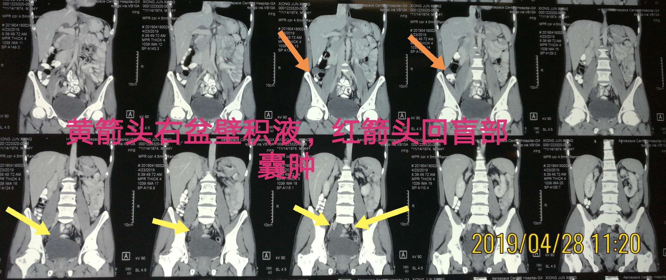 病例52右下腹囊肿伴右盆腔积液腹腔镜探查