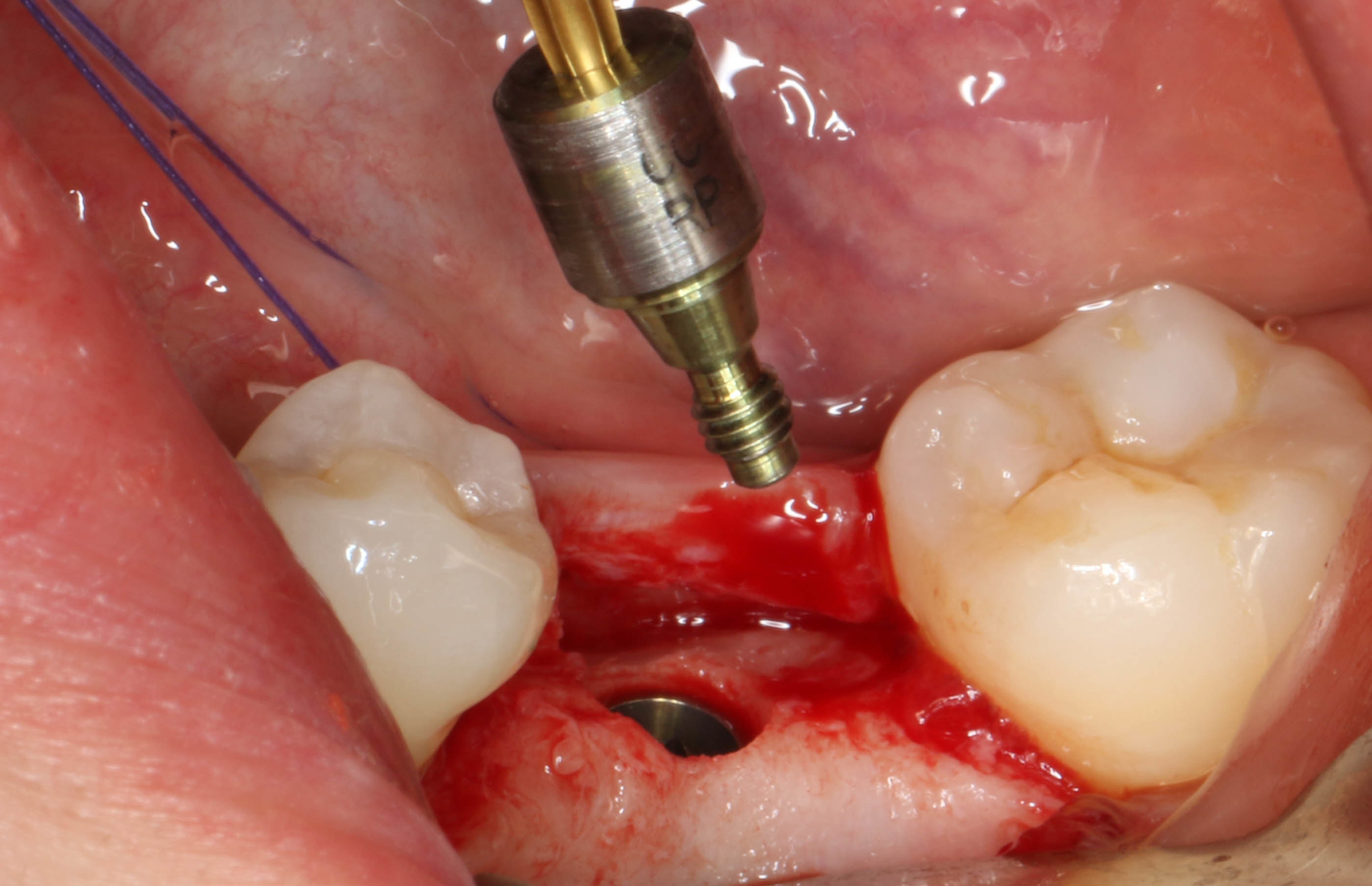 可见植体顶端颊侧牙槽骨较多,存在愈合基台不能完全就位的阻力