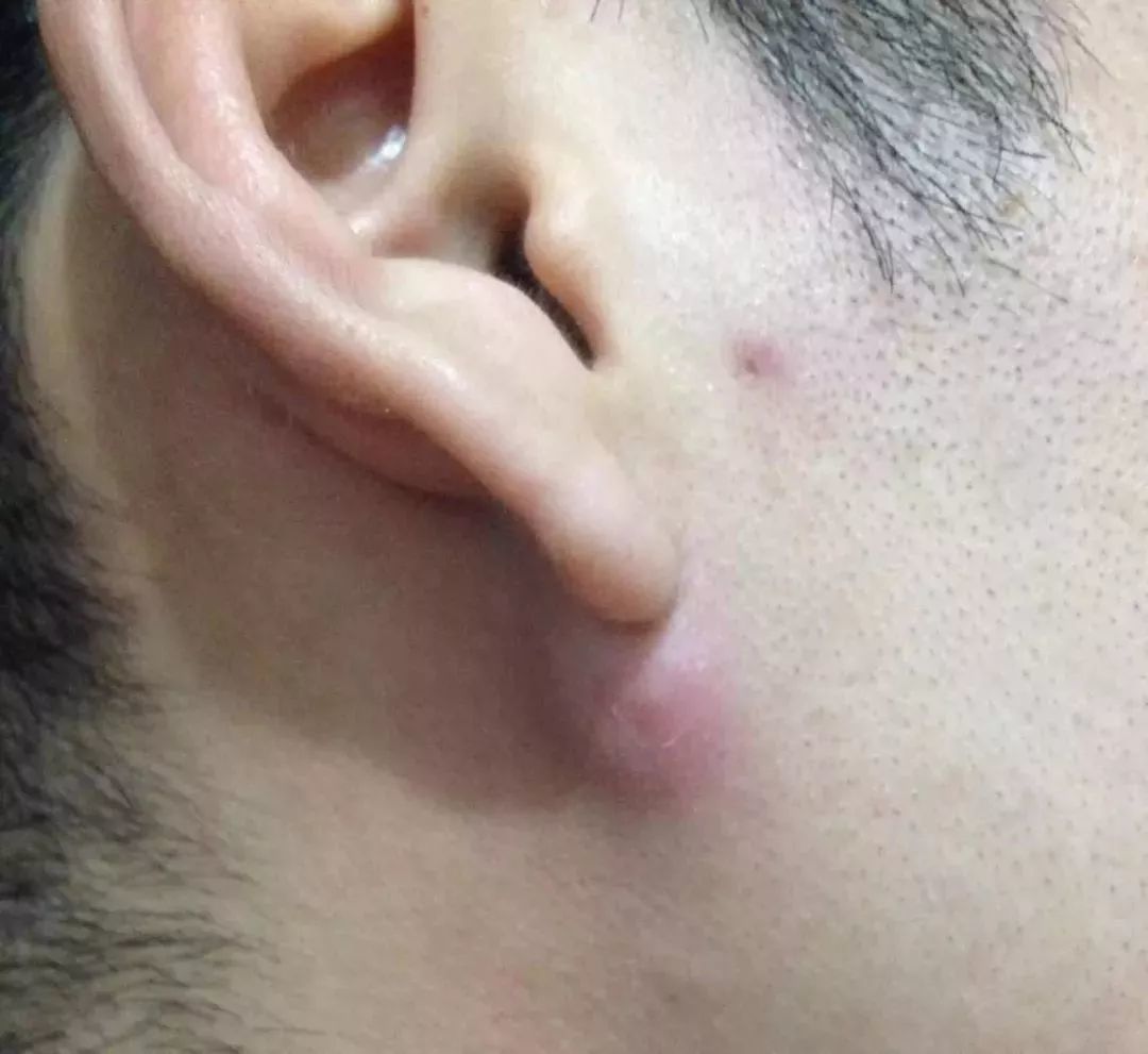 粉瘤:耳周常见的肿块_皮脂腺囊肿_疾病介绍_症状_治疗