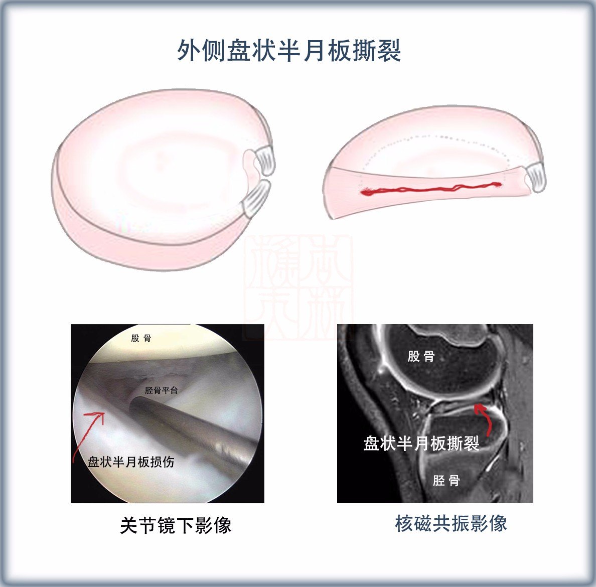 半月板损伤的最好治疗方法?哪种修复治疗方法好?效果如何?(含录像)