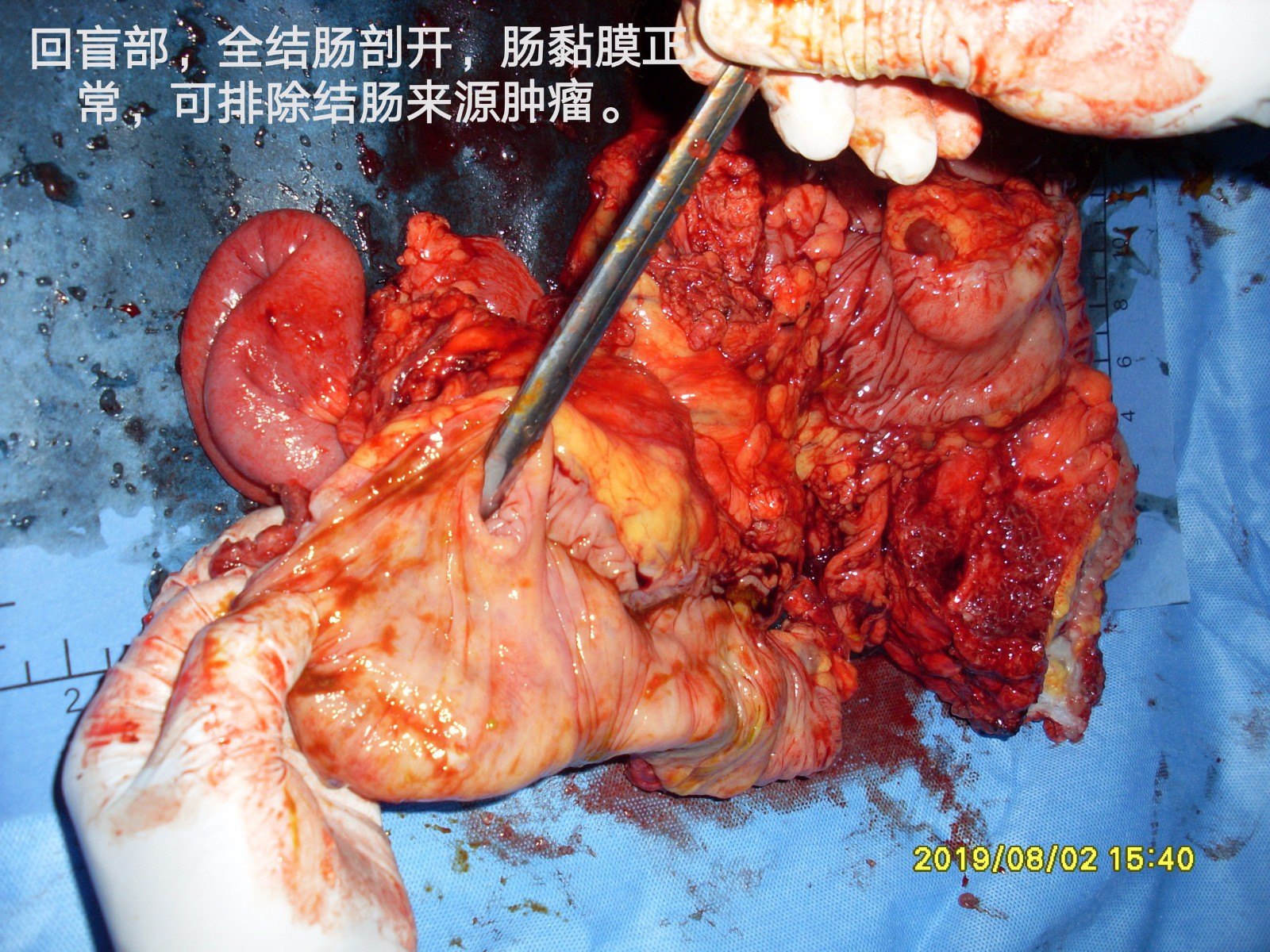 病例109-卵巢切除病理转移性黏液腺癌,7年后复发肠梗阻