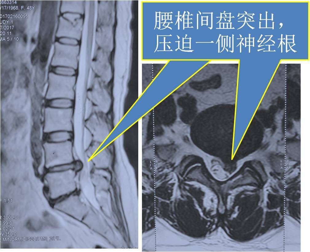 腰椎间盘突出症的症状,检查及治疗
