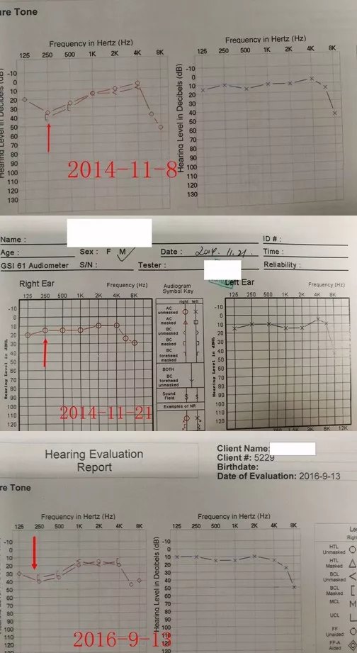 出现突发的耳闷,耳鸣,部分伴有眩晕,听力检查显示:低频感音神经性聋