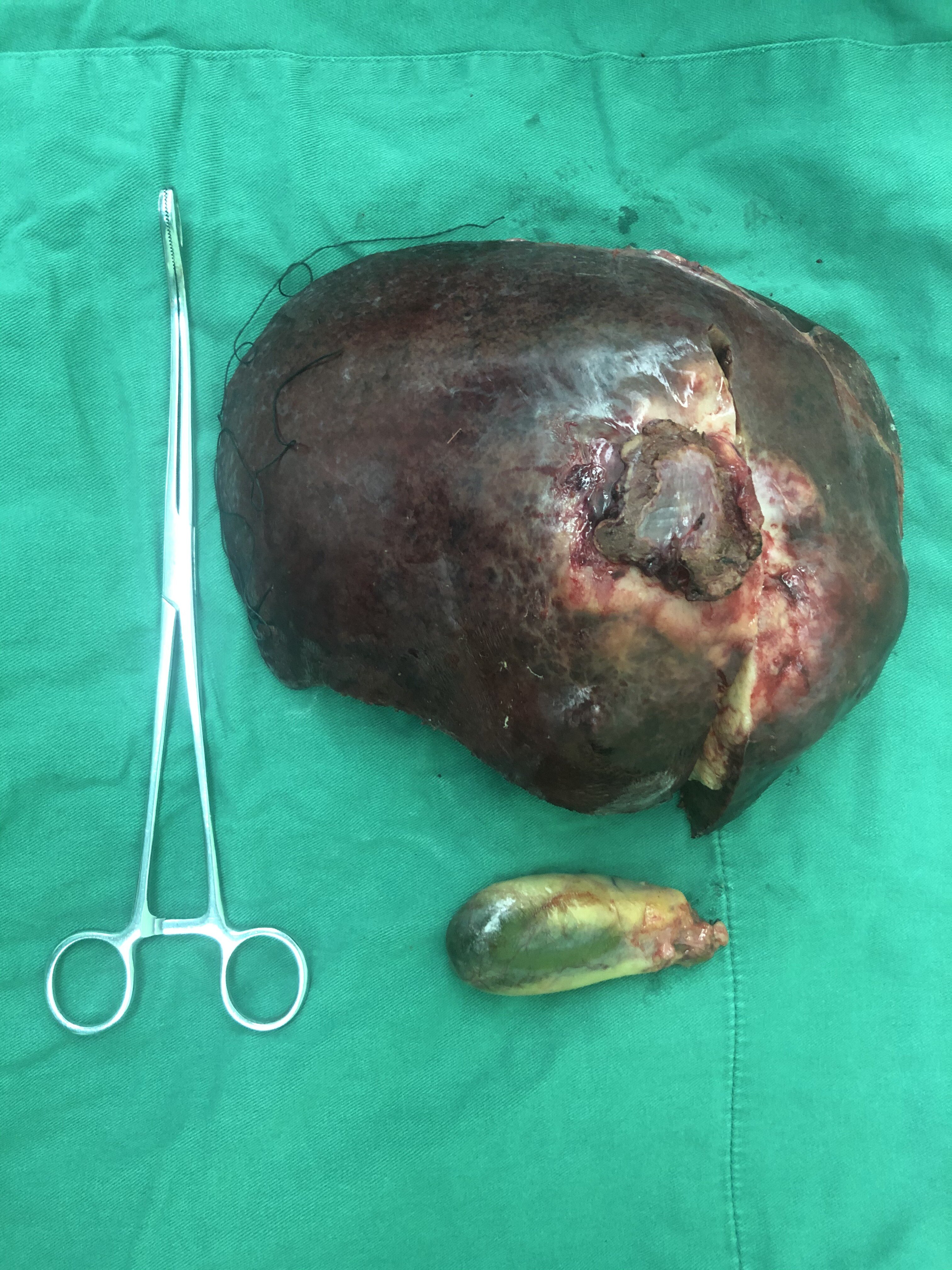 近日,我科完成一例巨大肝癌手术,采用右半肝切除术完整切除肿瘤,手术