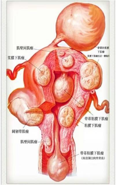 宫腔镜手术系列之三-子宫肌瘤_子宫肌瘤 好大夫在线